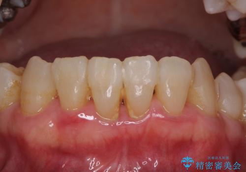 歯周病改善のための総合歯科治療の治療前
