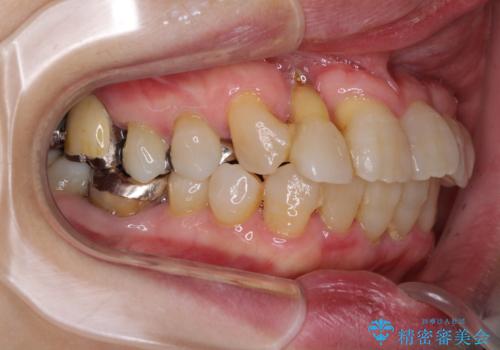 歯周病改善のための総合歯科治療の治療前