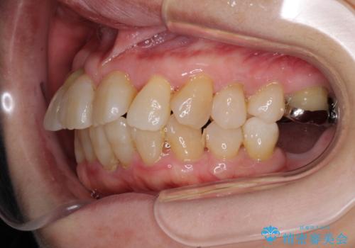 歯周病改善のための総合歯科治療の治療前
