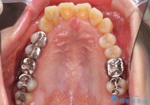 歯周病改善のための総合歯科治療の治療前