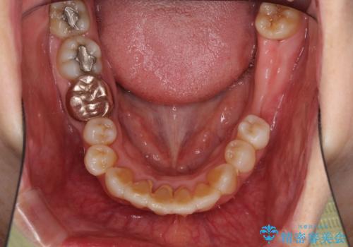 歯周病改善のための総合歯科治療の治療前