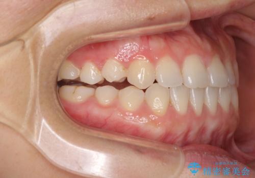 隙間の空いた前歯を治したい インビザライン矯正治療の治療中