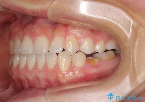 隙間の空いた前歯を治したい　インビザライン矯正治療の治療中
