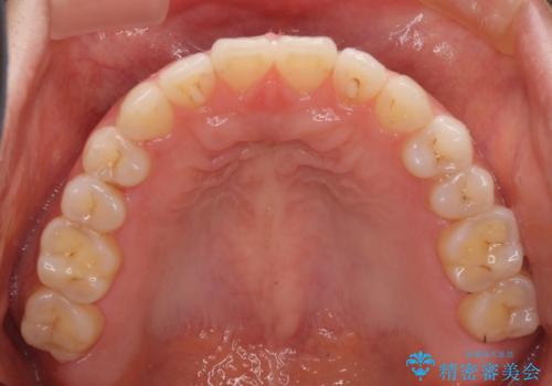 隙間の空いた前歯を治したい インビザライン矯正治療の治療中
