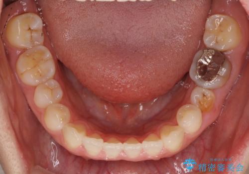 隙間の空いた前歯を治したい インビザライン矯正治療の治療中