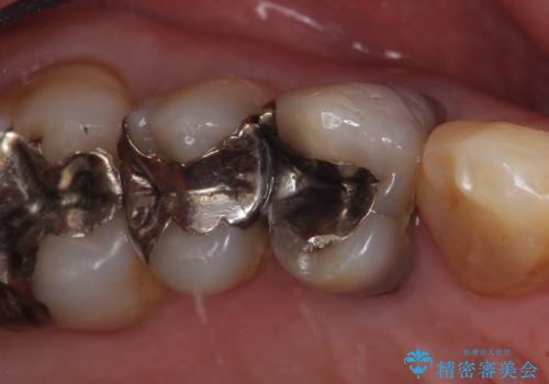 オールセラミッククラウン 変色した歯を白くの治療前