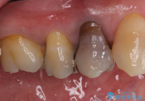 オールセラミッククラウン 変色した歯を白くの症例 治療前