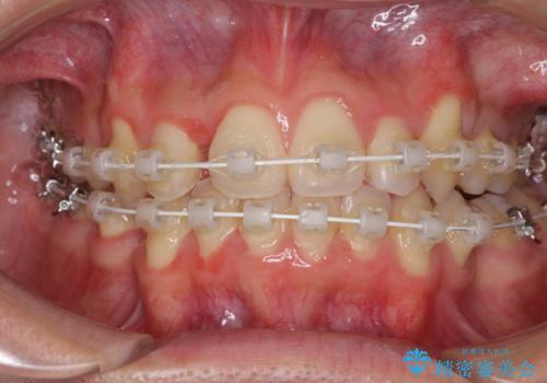 八重歯を治したい　目立たないワイヤー装置での抜歯矯正の治療中
