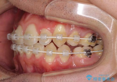八重歯を治したい 目立たないワイヤー装置での抜歯矯正の治療中