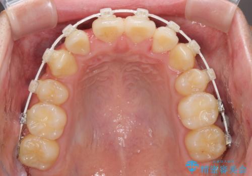 八重歯を治したい 目立たないワイヤー装置での抜歯矯正の治療中