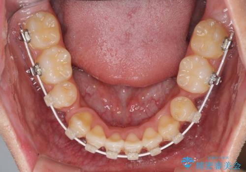八重歯を治したい 目立たないワイヤー装置での抜歯矯正の治療中