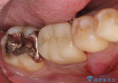 オールセラミッククラウン 膿が出続ける根の治療の治療前