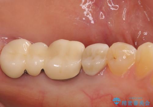 痛みを感じる奥歯 根管治療とインプラント治療の治療前