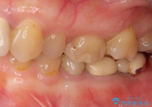 痛みを感じる奥歯 根管治療とインプラント治療の治療前