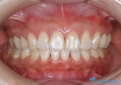 オフィスホワイトニング(エクセレント)の治療後