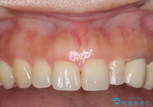 前歯が左右対称じゃない　保険の被せ物をきれいにしたい　ホワイトニング併用の症例 治療前