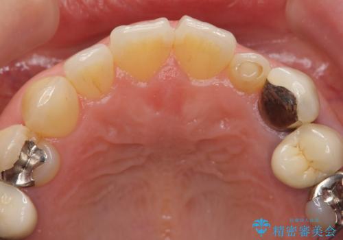 前歯が左右対称じゃない　保険の被せ物をきれいにしたい　ホワイトニング併用の治療前