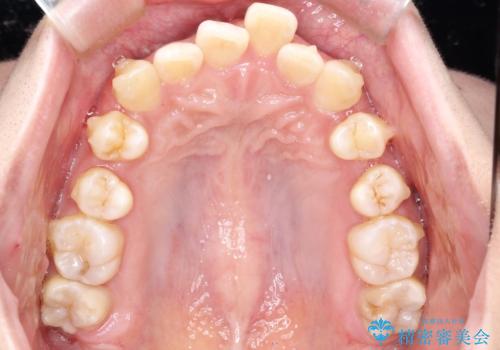 重度のガタガタのインビザラインによる非抜歯矯正の治療中