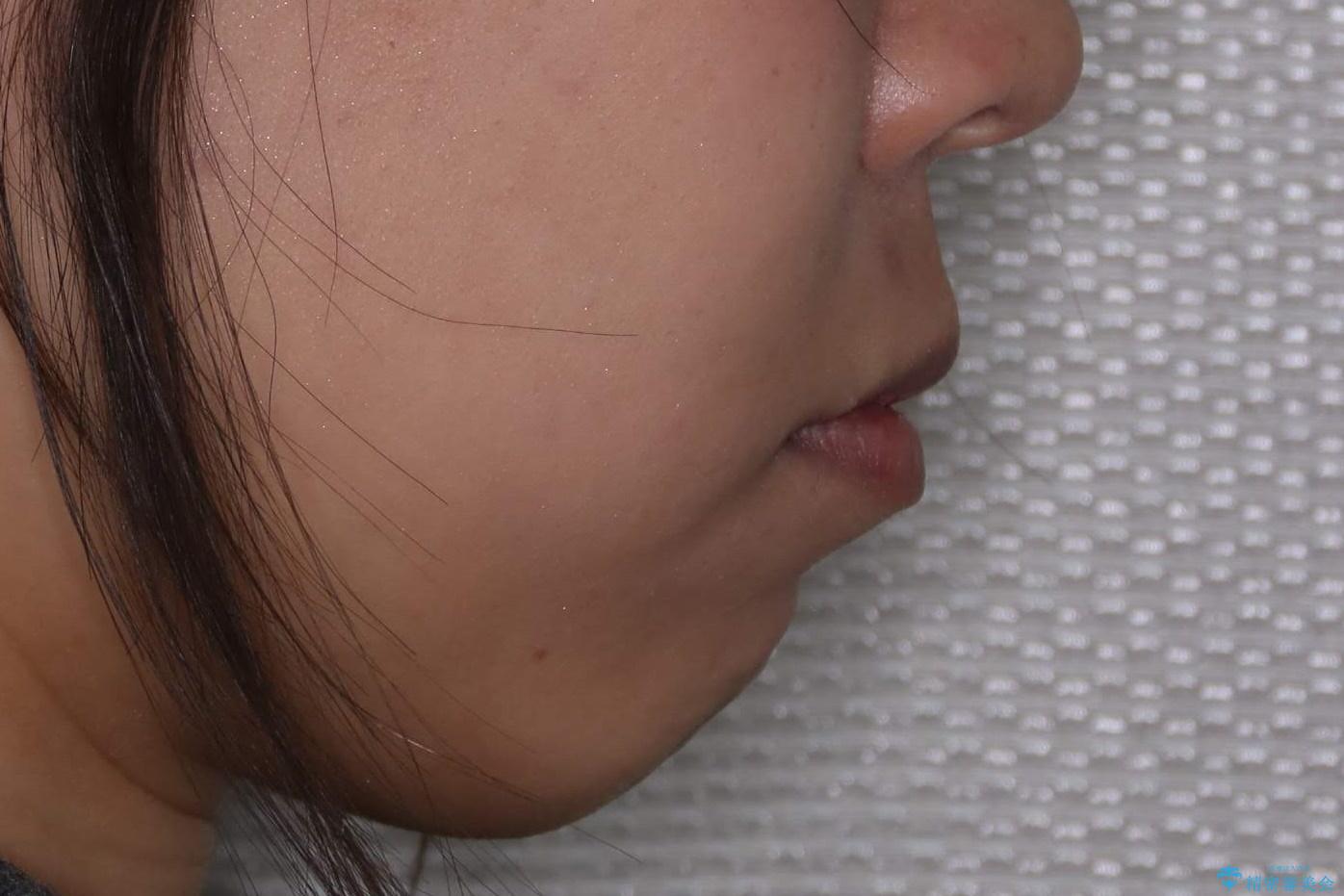歯が前に出てて、口が閉じない 抜歯矯正による口元の改善の治療前(顔貌)