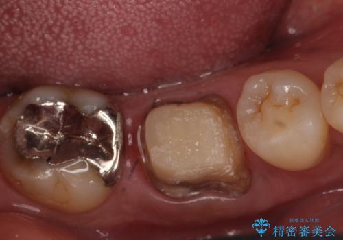 オールセラミッククラウン 膿が出続ける根の治療の治療中