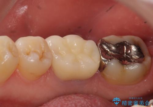 オールセラミッククラウン 膿が出続ける根の治療の治療後