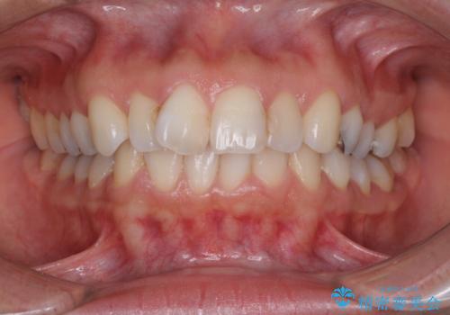 前歯の突出を軽減　インビザラインによる抜歯矯正の症例 治療前