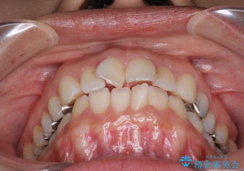 前歯の突出を軽減 インビザラインによる抜歯矯正の治療前