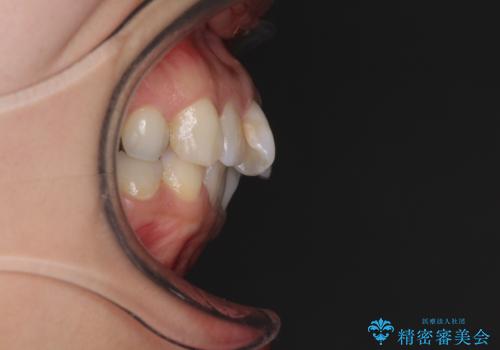 前歯の突出を軽減 インビザラインによる抜歯矯正の治療前