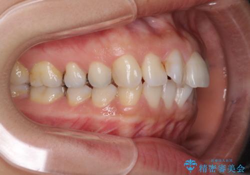 前歯の突出を軽減 インビザラインによる抜歯矯正の治療前
