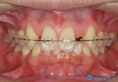 オールセラミッククラウン 部分矯正とセラミックによる前歯部の見た目の改善の治療後