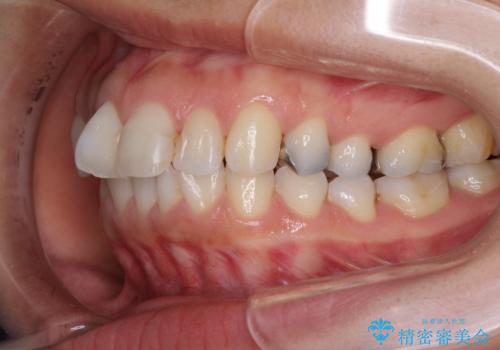 前歯の突出を軽減 インビザラインによる抜歯矯正の治療前