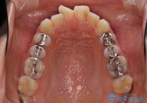 前歯の突出を軽減 インビザラインによる抜歯矯正の治療前
