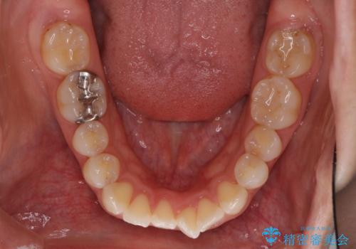 前歯の突出を軽減 インビザラインによる抜歯矯正の治療前