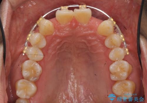 オールセラミッククラウン 部分矯正とセラミックによる前歯部の見た目の改善の治療後
