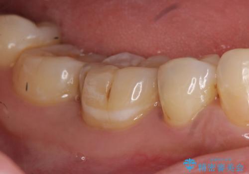 オールセラミッククラウン セラミックインレー しみる奥歯の治療の治療前