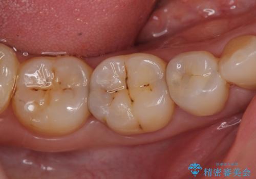 オールセラミッククラウン セラミックインレー しみる奥歯の治療の治療前