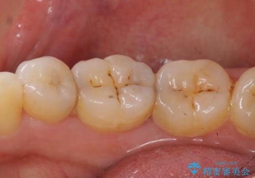 オールセラミッククラウン セラミックインレー しみる奥歯の治療の症例 治療前