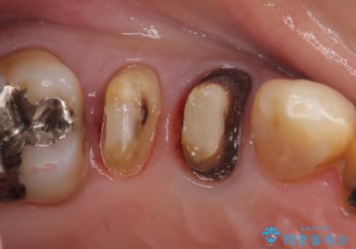 オールセラミッククラウン 変色した歯を白くの治療中