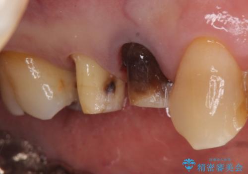 オールセラミッククラウン 変色した歯を白くの治療中