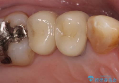 オールセラミッククラウン　変色した歯を白くの治療後