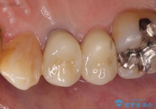 オールセラミッククラウン 変色した歯を白くの治療後