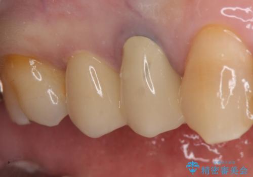 オールセラミッククラウン 変色した歯を白くの症例 治療後