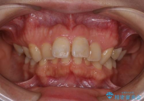 インビザライン矯正治療の型どり前にPMTCの治療前