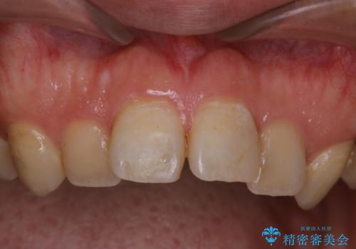 インビザライン矯正治療の型どり前にPMTCの治療前