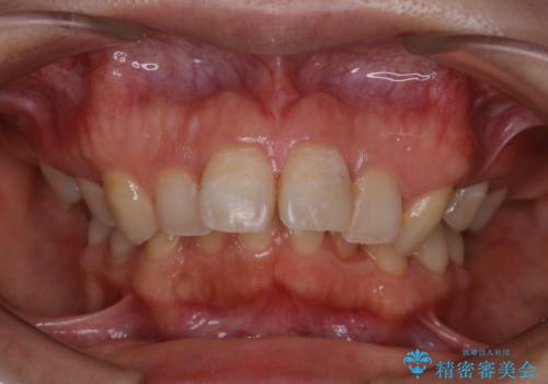 インビザライン矯正治療の型どり前にPMTCの治療後