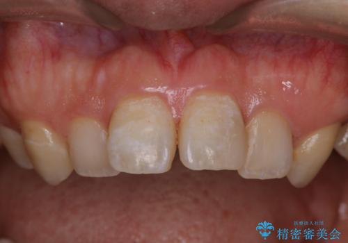 インビザライン矯正治療の型どり前にPMTCの治療後