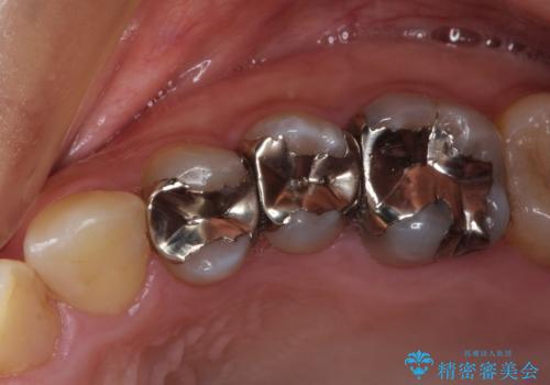 見える金属を白くしたい、セラミック治療の症例 治療前
