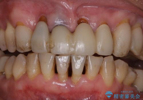 ワインによる着色をPMTCでキレイに