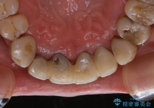 ワインによる着色をPMTCでキレイにの治療前