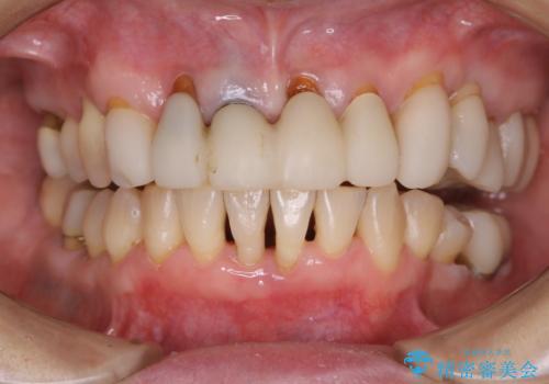 ワインによる着色をPMTCでキレイにの治療後